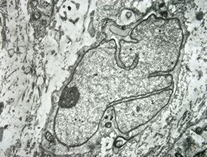 F,12y. | malignant schwannoma v.s. … neurofibrosarcoma ? F,12y. | malignant schwannoma v.s. … neurofibrosarcoma ?